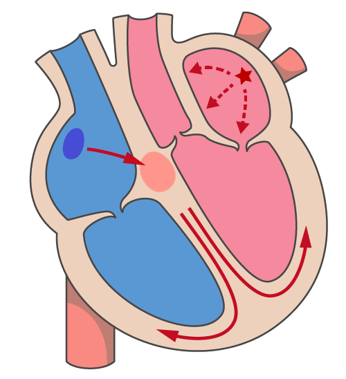 心房細動の原因と仕組みのイラスト